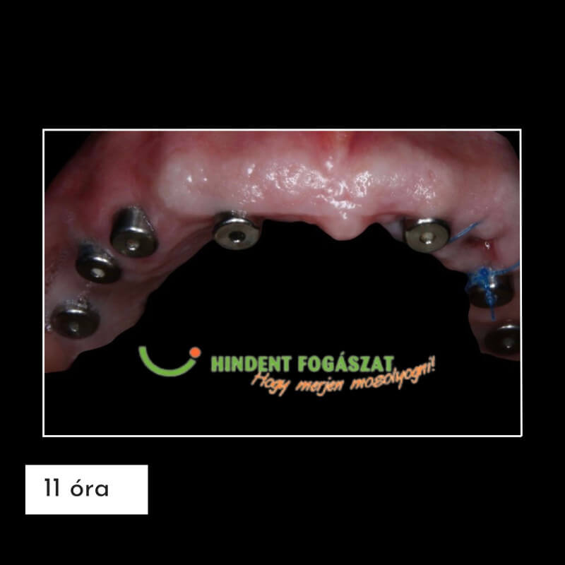 Teljes fogatlanság esetén ún. fogászati implantátumokra épül maga a fogpótlás